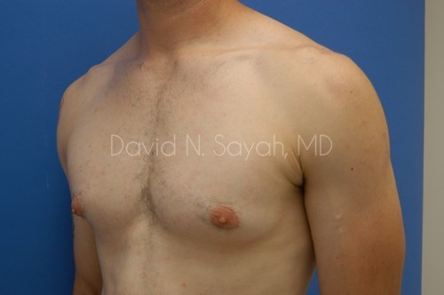 Liposuction Before and After | simply males