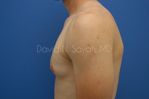 Liposuction Before and After | simply males