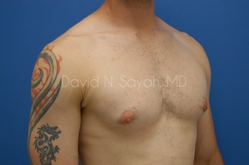 Liposuction Before and After | simply males