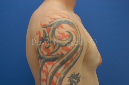 Liposuction Before and After | simply males