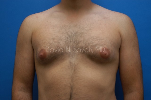 Liposuction Before and After | simply males