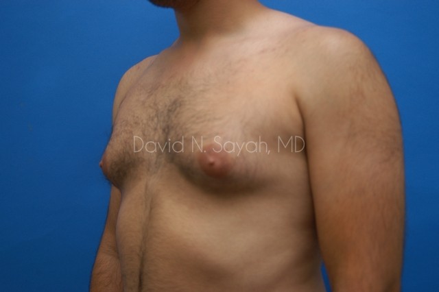 Liposuction Before and After | simply males