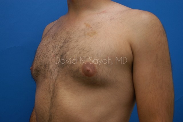 Liposuction Before and After | simply males