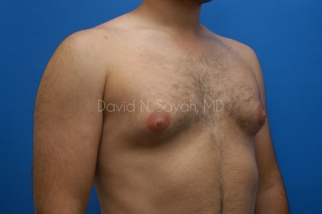 Liposuction Before and After | simply males