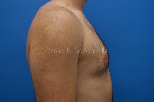 Liposuction Before and After | simply males