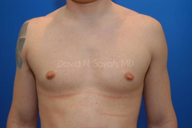 Liposuction Before and After | simply males