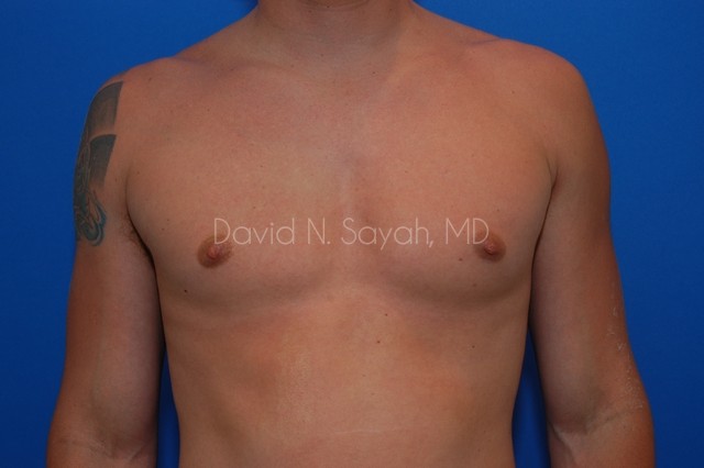 Liposuction Before and After | simply males