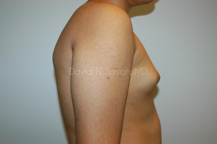 Liposuction Before and After | simply males