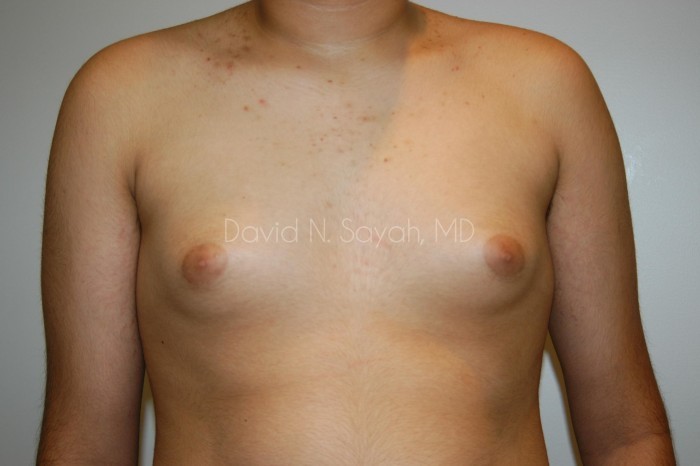 Liposuction Before and After | simply males