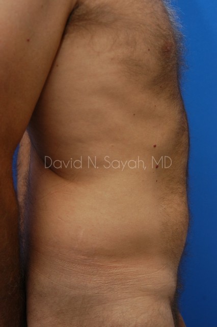 Liposuction Before and After | simply males