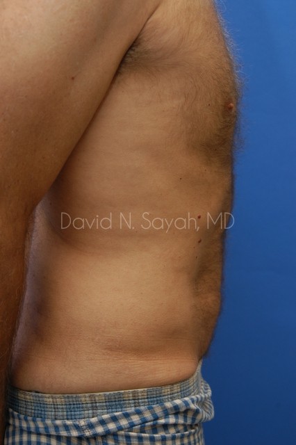 Liposuction Before and After | simply males