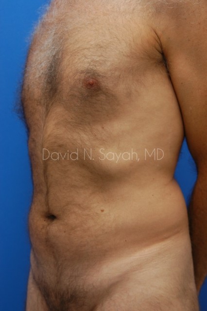 Liposuction Before and After | simply males