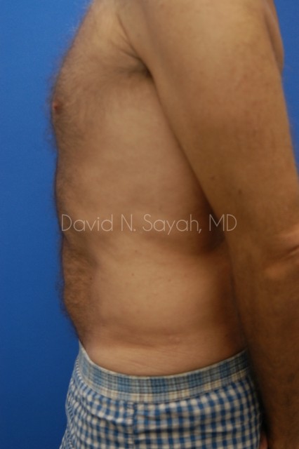 Liposuction Before and After | simply males