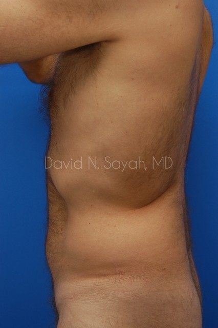 Liposuction Before and After | simply males