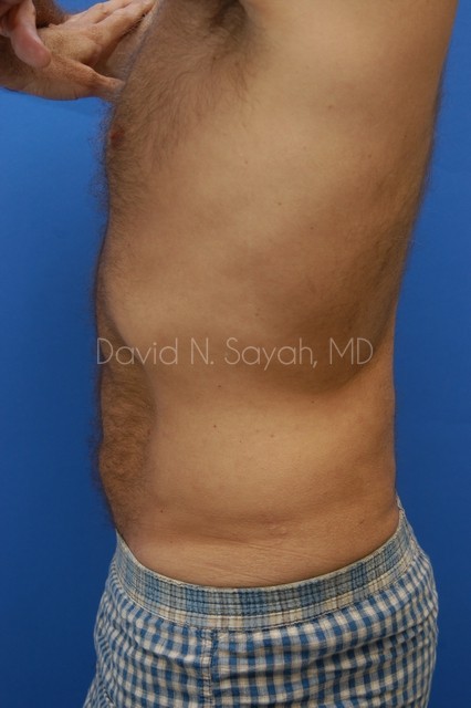 Liposuction Before and After | simply males