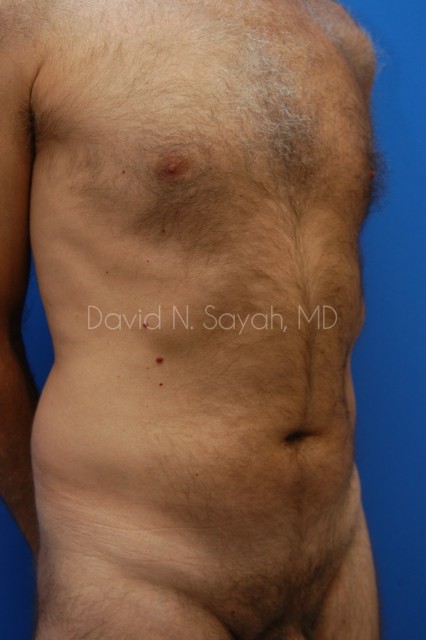 Liposuction Before and After | simply males