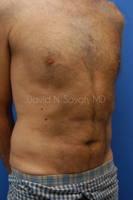 Liposuction Before and After | simply males