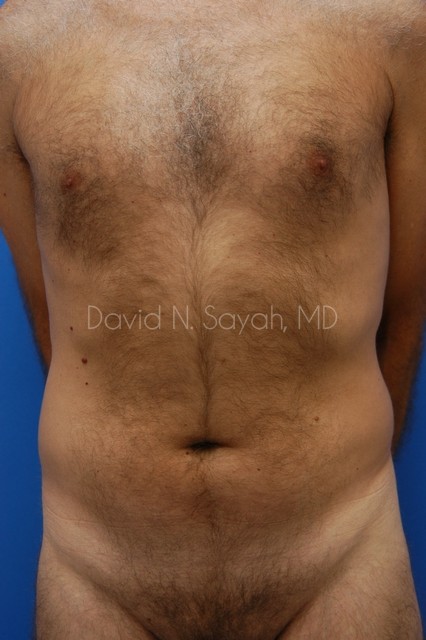 Liposuction Before and After | simply males