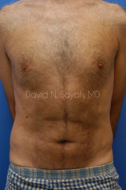 Liposuction Before and After | simply males