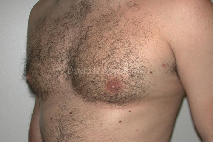 Liposuction Before and After | simply males