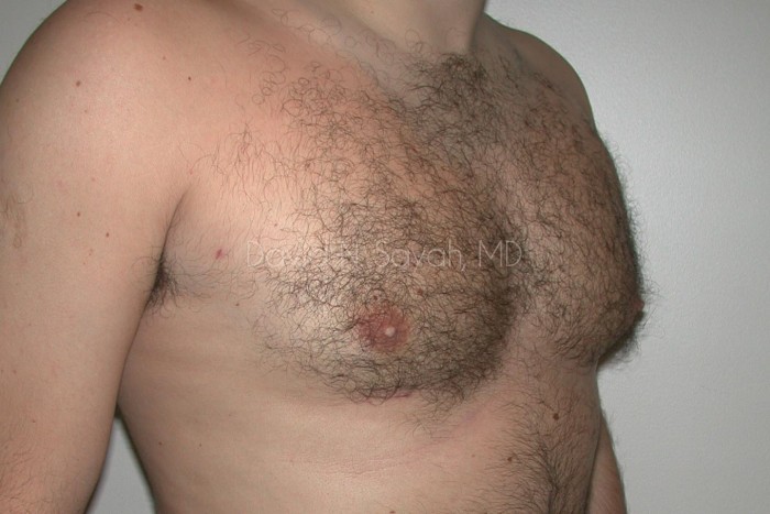 Liposuction Before and After | simply males