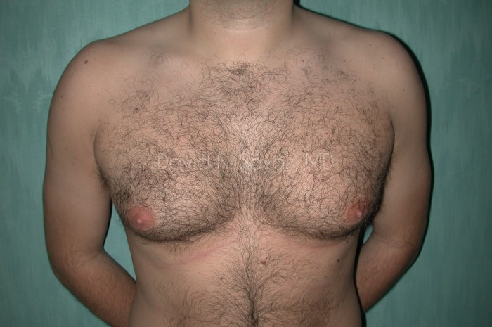 Liposuction Before and After | simply males