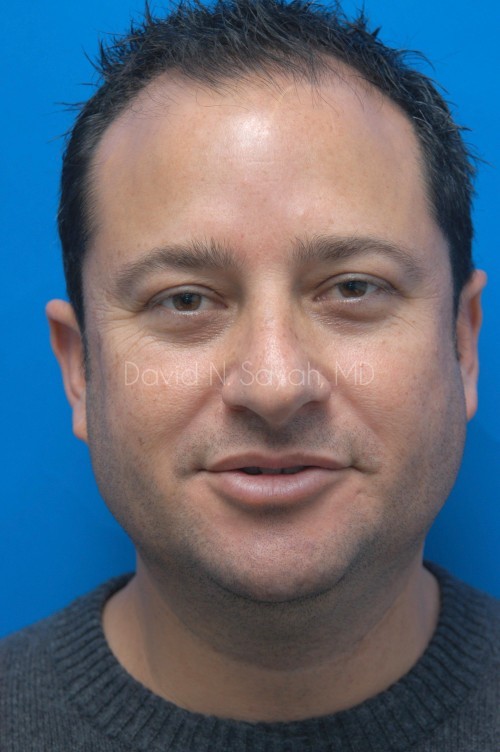 Neck Lift Before and After | simply males