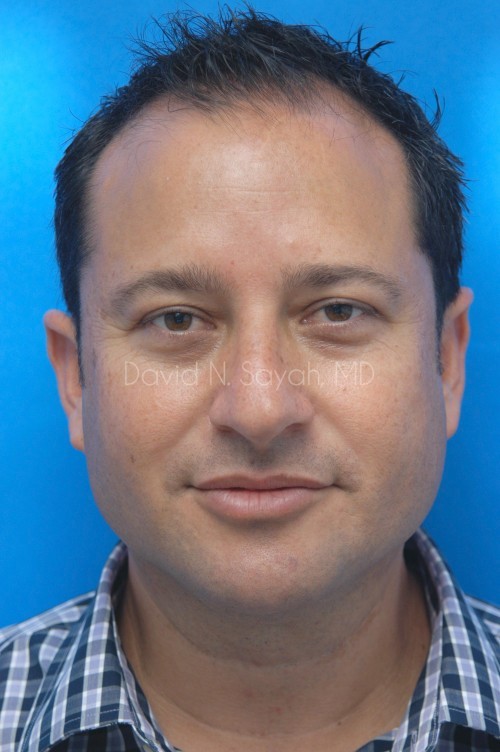 Neck Lift Before and After | simply males