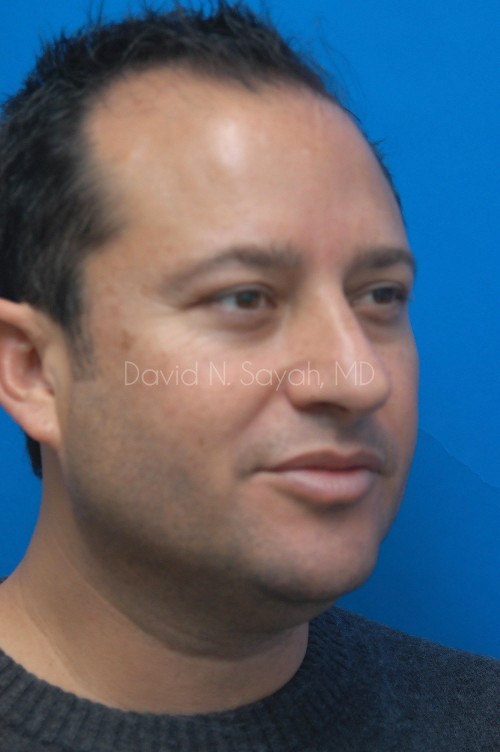 Neck Lift Before and After | simply males