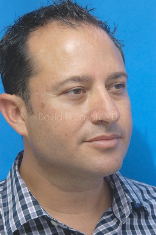 Neck Lift Before and After | simply males