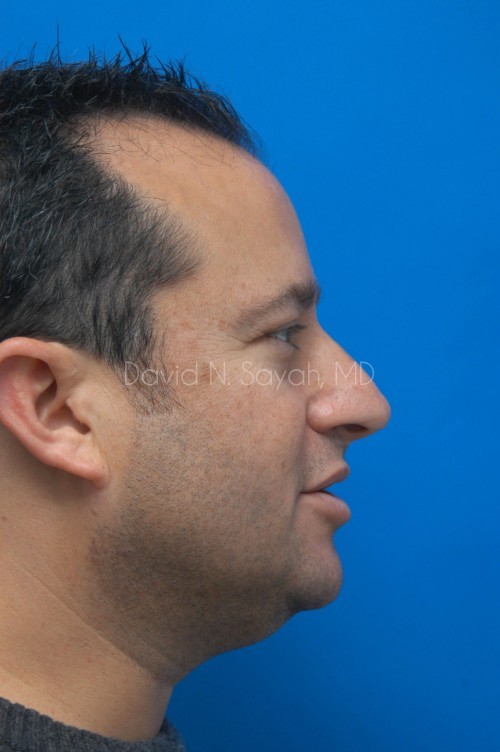 Neck Lift Before and After | simply males