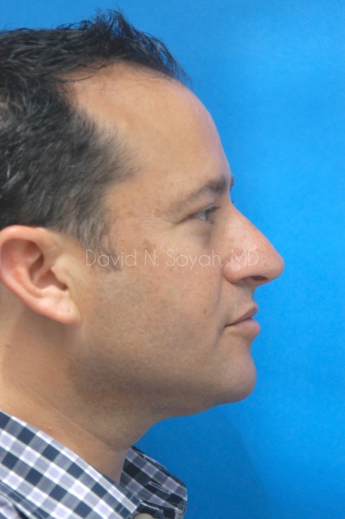 Neck Lift Before and After | simply males