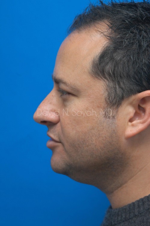 Neck Lift Before and After | simply males