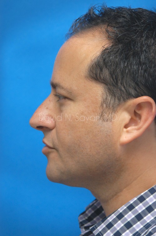 Neck Lift Before and After | simply males