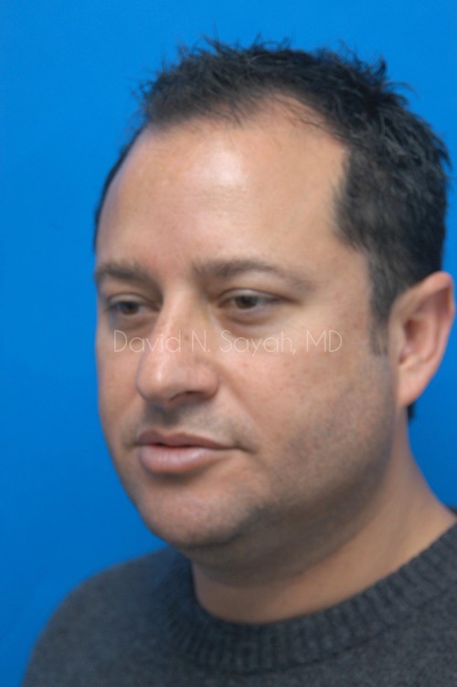 Neck Lift Before and After | simply males