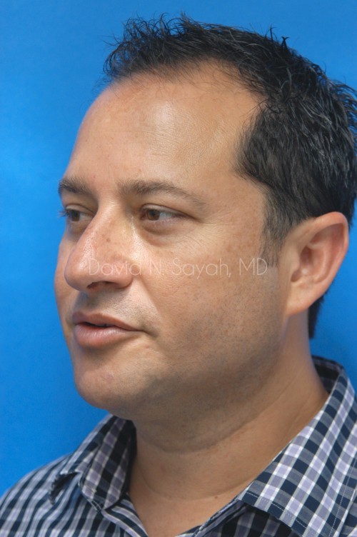 Neck Lift Before and After | simply males