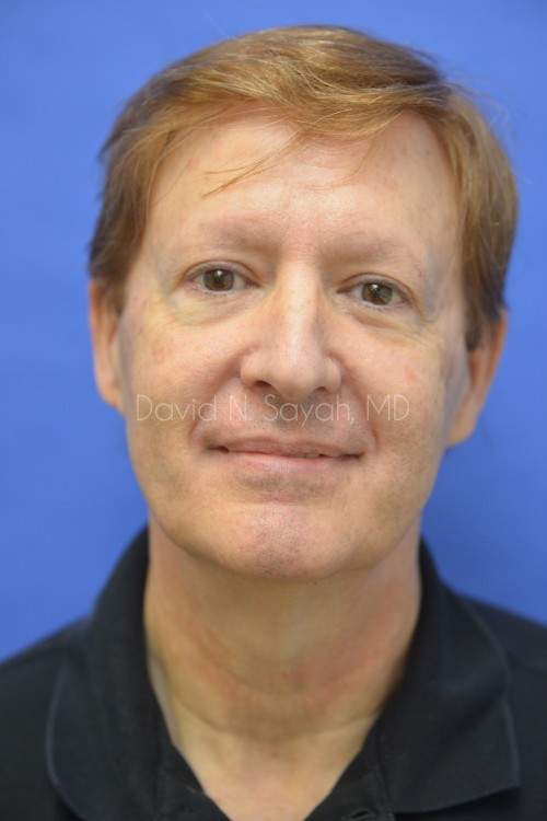 Neck Lift Before and After | simply males