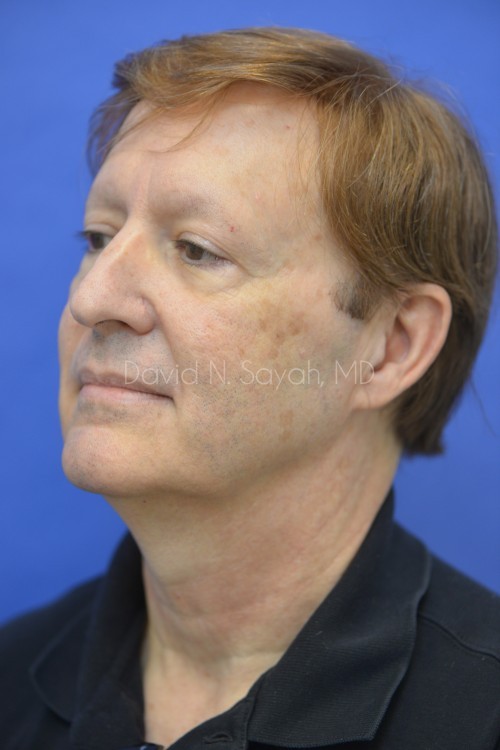 Neck Lift Before and After | simply males