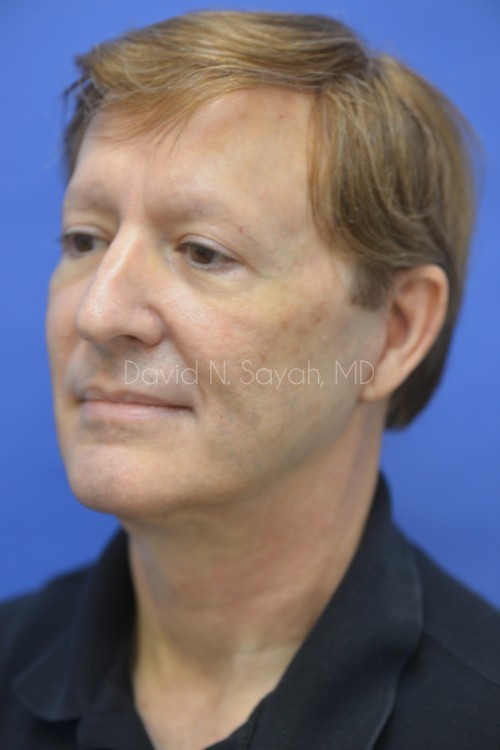 Neck Lift Before and After | simply males