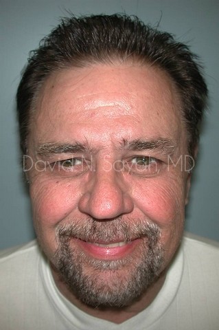 Neck Lift Before and After | simply males