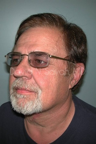 Neck Lift Before and After | simply males