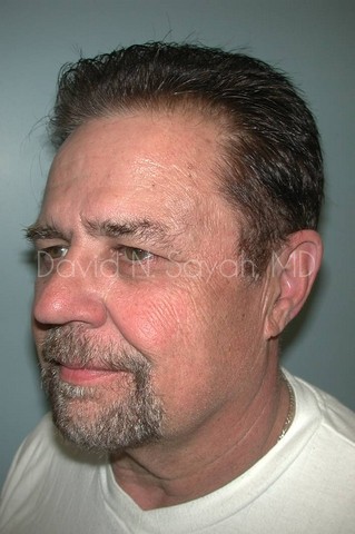 Neck Lift Before and After | simply males