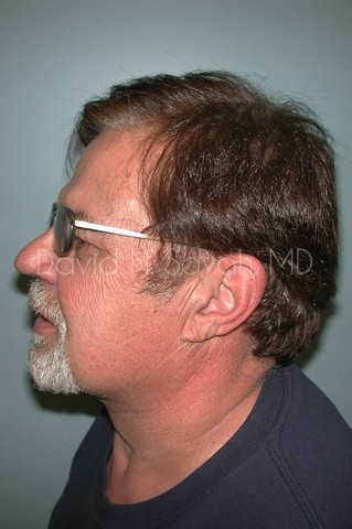 Neck Lift Before and After | simply males