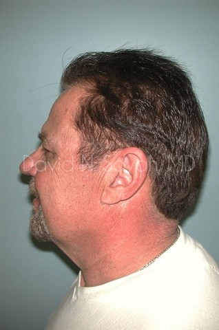 Neck Lift Before and After | simply males