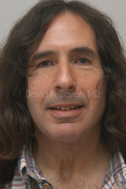 Neck Lift Before and After | simply males