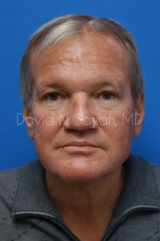 Neck Lift Before and After | simply males