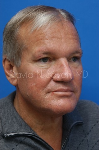 Neck Lift Before and After | simply males