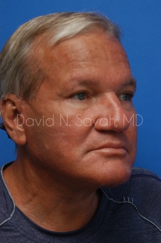 Neck Lift Before and After | simply males