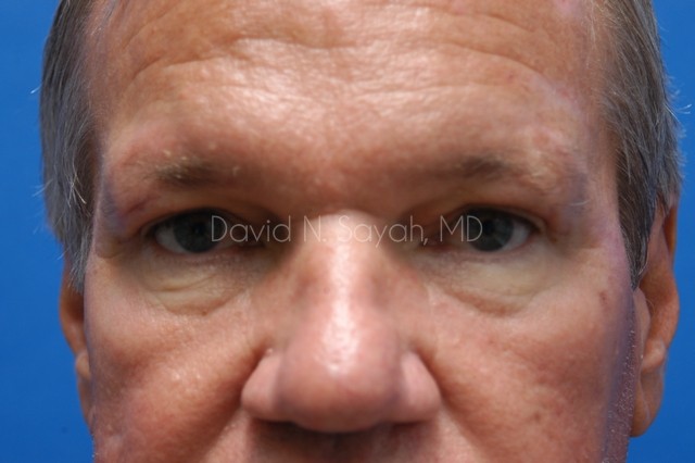 Neck Lift Before and After | simply males