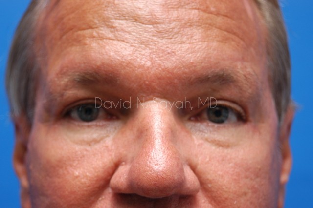 Neck Lift Before and After | simply males